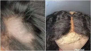 How to Fix a balding frontal  permantely😱