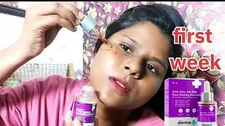 First week The Derma Co 15% АНА + 1% ВНА Beginner Face Peeling Solution Review And Demo |
