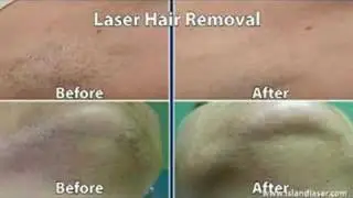 Benefits & Technology of Laser Hair Removal