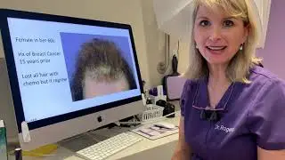 Hair Loss After Chemo Therapy Treated