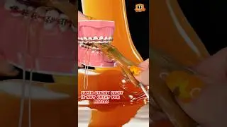 Is CARAMEL safe for BRACES!? *my REACTION #braces #caramel #satisfying