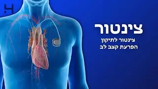 צינטור לתיקון הפרעת קצב לב | CUT מנתחים | הדסה טי וי