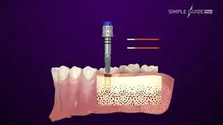 DENTIS Dental Guide System - SIMPLE GUIDE Plus (Korean)
