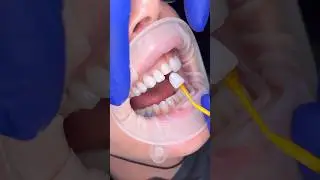 Ultra thin minimal prep veneers #veneers #dentistry #smilemakeover #veneerbeforeandafter #satisfying