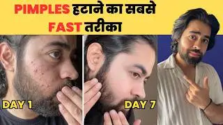 Best Skincare Products for Acne Prone Skin | Pimples Gone, No Confusion