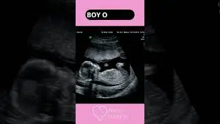 Determining the gender of a baby by looking at an ultrasound | AM