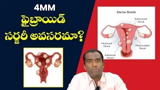 4mm Fibroid: Is Surgery Necessary? | Dr. Shailesh Kumar Explains |Non-Surgical Fibroid Treatment? |
