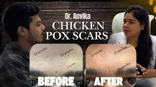 Chicken Pox Scar Removal || Before & After Results || Chicken Pox Scar Transformation ||