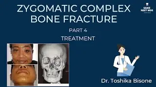 Treatment of Zygomatic complex bone fracture | Part 4