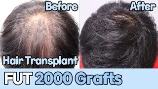 FUT 2000 Grafts｜Hair transplant｜Hairline correction｜SMP｜DANA