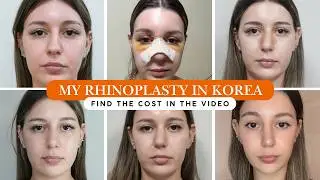 My korean nose job| Cost, Procedure & 4-month Update