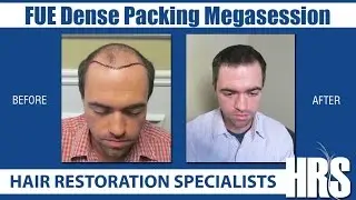 FUE Dense Packing Megasession - Hair Restoration Specialists of Atlanta
