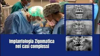 IMPLANTOLOGIA ZIGOMATICA nei casi complessi
