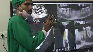 PART- 41 Cortico basal dental implant course Nov-2023 lower second premolar-planning for replacement