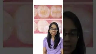 Dental sealants ✨
