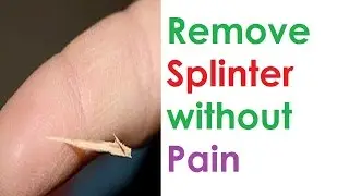 5 Safe And Painless Ways To Remove And Treat A Splinter | How To Remove A Splinter Without Pain