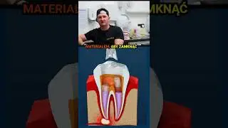 😱Jak Wygląda Leczenie Kanałowe?🦷😳 (Krok Po Kroku) (Animacja 3D)