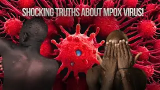 Monkeypox Outbreak 2024: Symptoms, Prevention, & Updates!