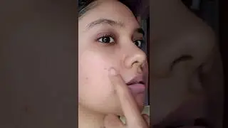 👆🏻7 days Acne Challenge😱❓#shorts #viralshorts #shortsfeed #acnejourney #acnetreatment #acneproneskin