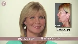 Skin and Vein Y Lift Commercial
