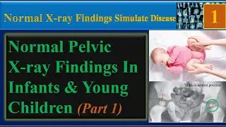 Pelvic X-ray, Normal Findings In Infants & Young Children