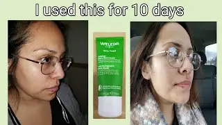 Крем Weleda Skin Food Ultra Rich Cream – средство от себорейного дерматита