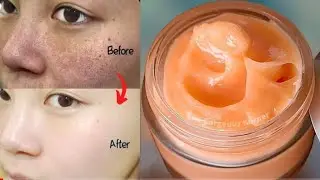 Pigmentation dark spots remove permently a power remedy for melasma & hyper #veerakiduniya