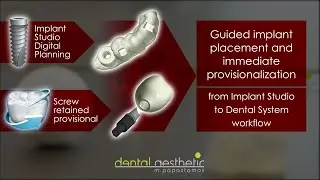 Immediate provisionalization with screw-retained crown from Implant Studio Planning.