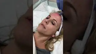 Microneedling @ The Functional Medicine MD