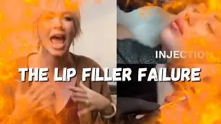 Неудача с филлером для губ