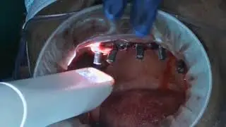 live - implant scanning with scan bodies for titanium bar