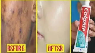 In 7 Days Remove Dark Spots Fast Naturally  Using Toothpaste