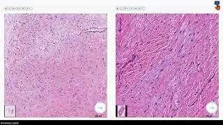 Managing Risk in Soft Tissue and Bone Pathology: Dr. Paari Murugan, University of Minnesota
