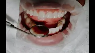 Carillas en Resina a mano alzada!