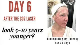 6 days after CO2 laser. - It's REALLY RED.