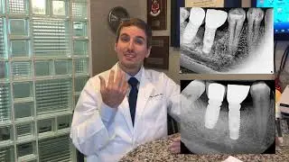 What is Peri-implantitis?