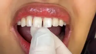 Front teeth me gap tha&hellip; aur smile ruk gayi thi!Diastema Correction ke baad &mdash; Smile Bilkul Flawless✨😁