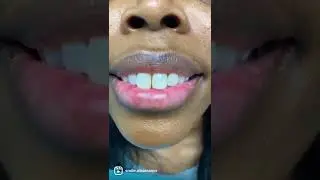10 Porcelain Veneers