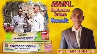Asclepius Wellness Private Limited || #awpl DENTODOC CREAM || RESULT💥💯 #video #viralvideo #awplayush