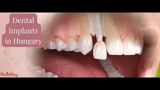 Why Thousands of Europeans Are Choosing Dental Implants in Hungary