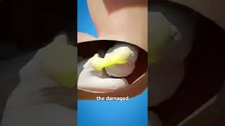 Tommy John Surgery 🤔 (explained)