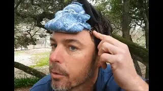 Skull pressure weights for a receding hairline