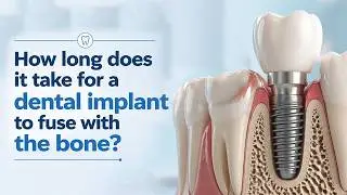 How long does it take for a dental implant to fuse with the bone?