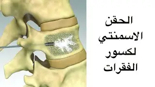 عملية الحقن الاسمنتي لعلاج كسر الفقرات بالظهر
