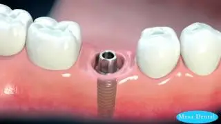 Dental Implants - The  Mesa Dental Difference