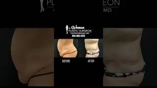 Mommy Makeover After Losing 112 Lbs | Tummy Tuck by Dr. Cynthia Mizgala #weightlossjourney