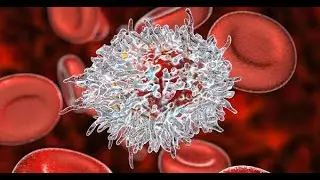 Chylothorax Associated with Acute Lymphoblastic Leukemia