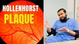 Hollenhorst Plaque:Closer Look with Dr.Usman Akbar- Expert Tips for Effective Patient Care #drusman