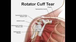 GEM- FREE LECTURE- DOES ROTATOR CUFF INJURY NEED SURGERY? BY CANADIAN PHYSIO DR.  HASAN RAHMAN #free
