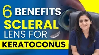 Top 6 Benefits of Scleral Lenses for Keratoconus